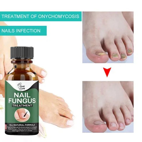 Nail Fungal Repair Serum - IMPORTED