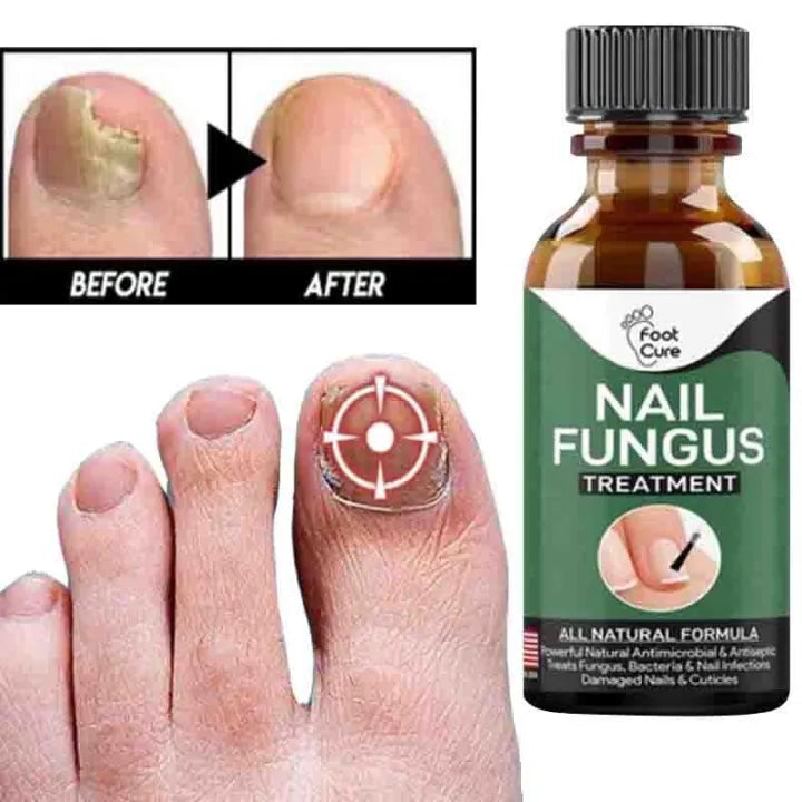 Nail Fungal Repair Serum - IMPORTED